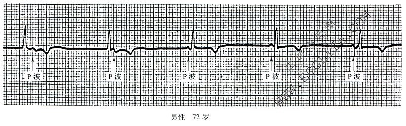 房室脱节