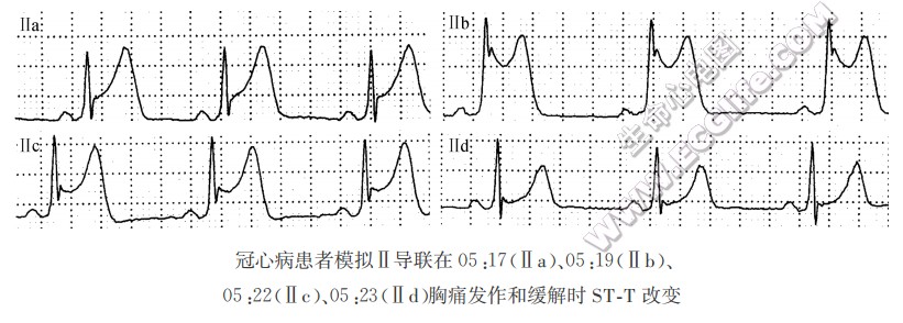 ST段抬高的诊断与鉴别诊断