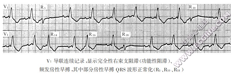 早搏波形正常化