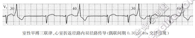 心房、心室折返径路内双径路、多径路传导