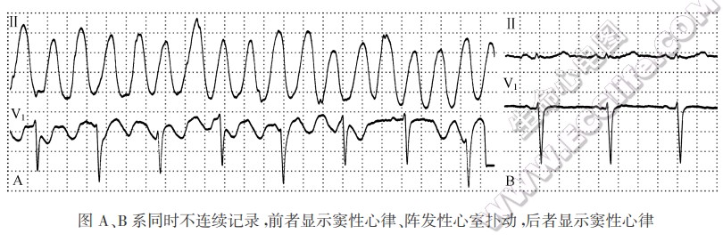 心室分离：阻滞性、干扰性心室分离