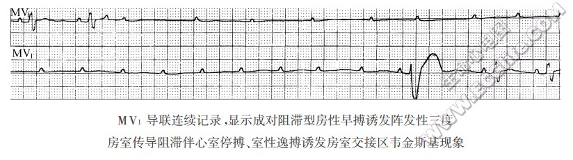 房性早搏揭示（或诱发）阵发性三度房室传导阻滞
