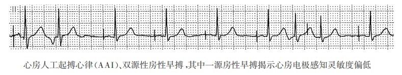 房性早搏揭示心房电极感知功能不良