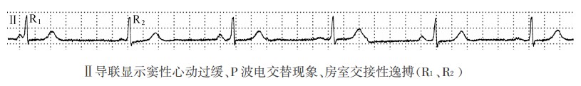 P波电交替现象的心电图特征、发生机制、临床意义