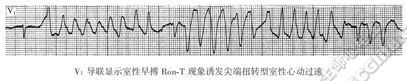 尖端扭转型室性心动过速