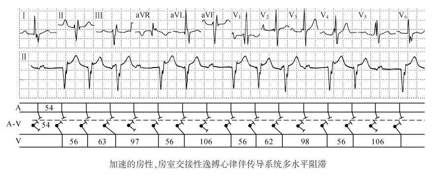 加速的房性、房室交接性逸搏心律伴传导系统多水平阻滞