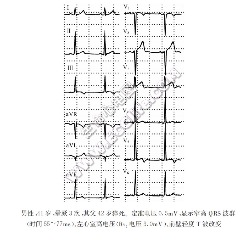 窄高QRS波综合征