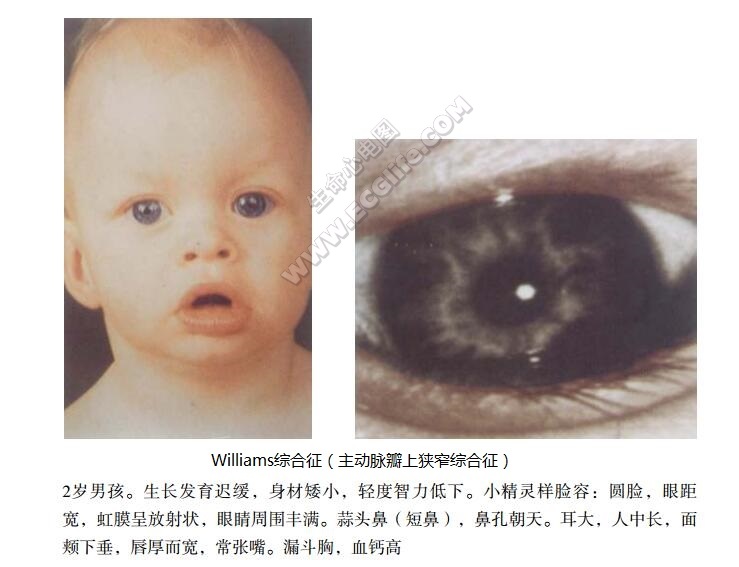 Williams综合征（主动脉瓣上狭窄综合征）