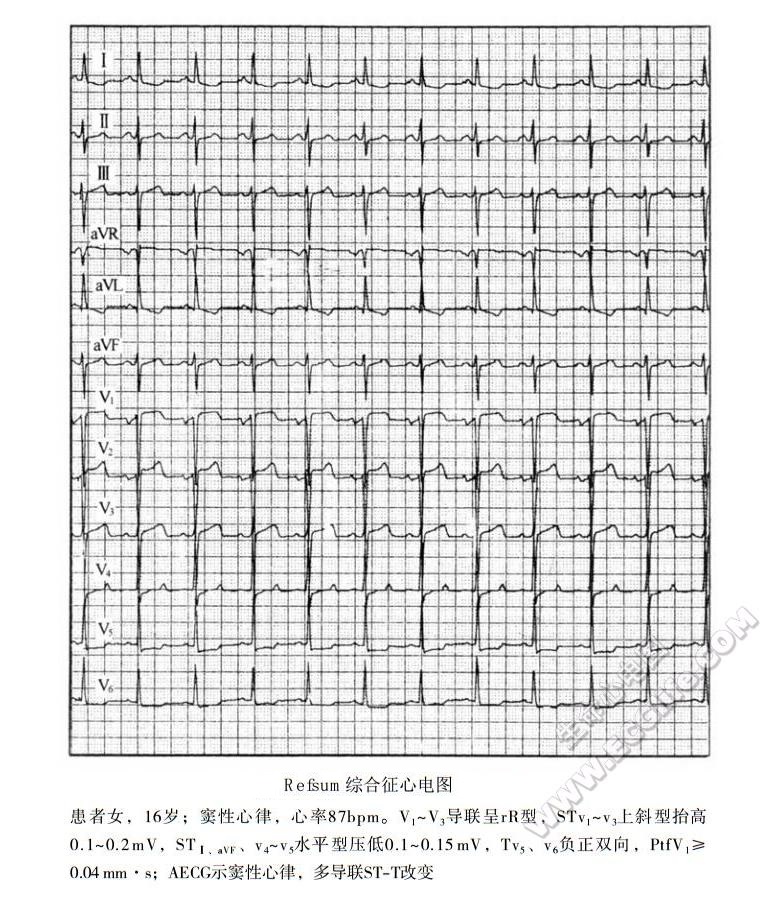 Refsum综合征（雷夫叙姆病、共济失调-多发性神经炎综合征）