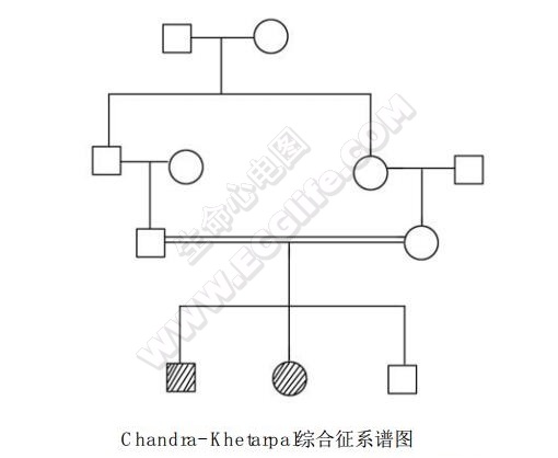 Chandra-Khetarpal（支气管扩张-鼻窦旁不发育-左位心）