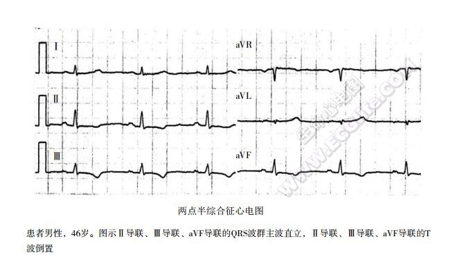 两点半综合征