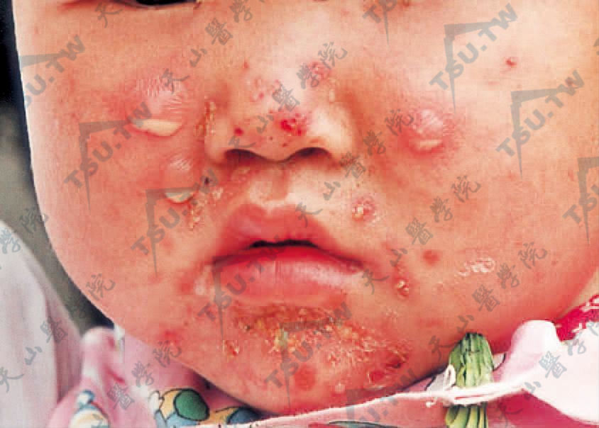 脓疱疮（Impetigo、黄水疮）病因、症状、诊疗参考