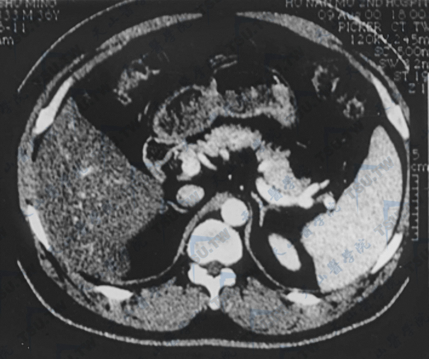 肾上腺CT