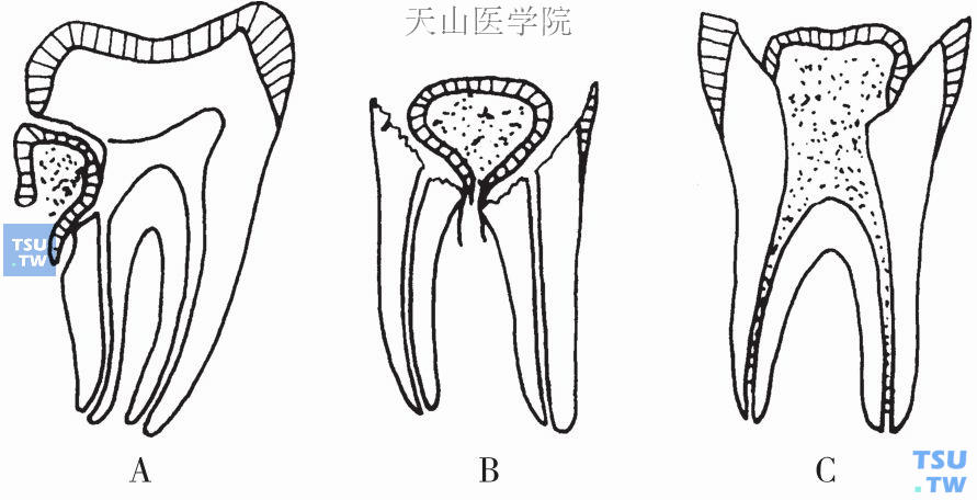 牙髓疾病的分类及临床表现