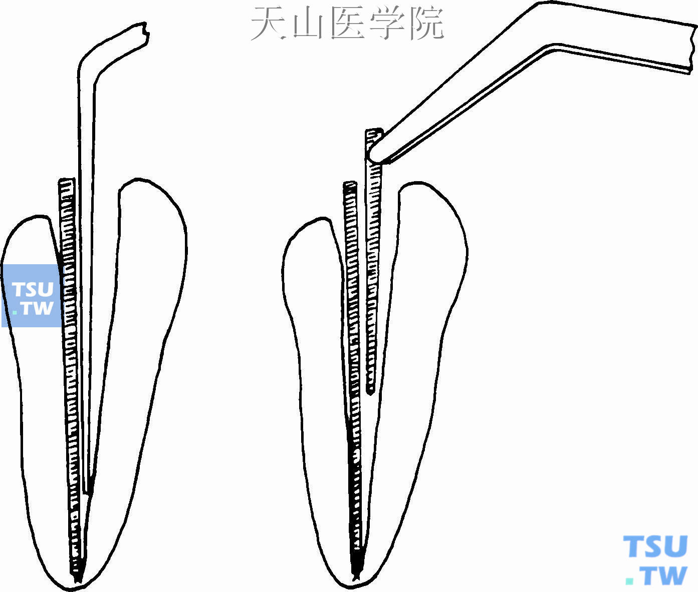 根尖周病的治疗