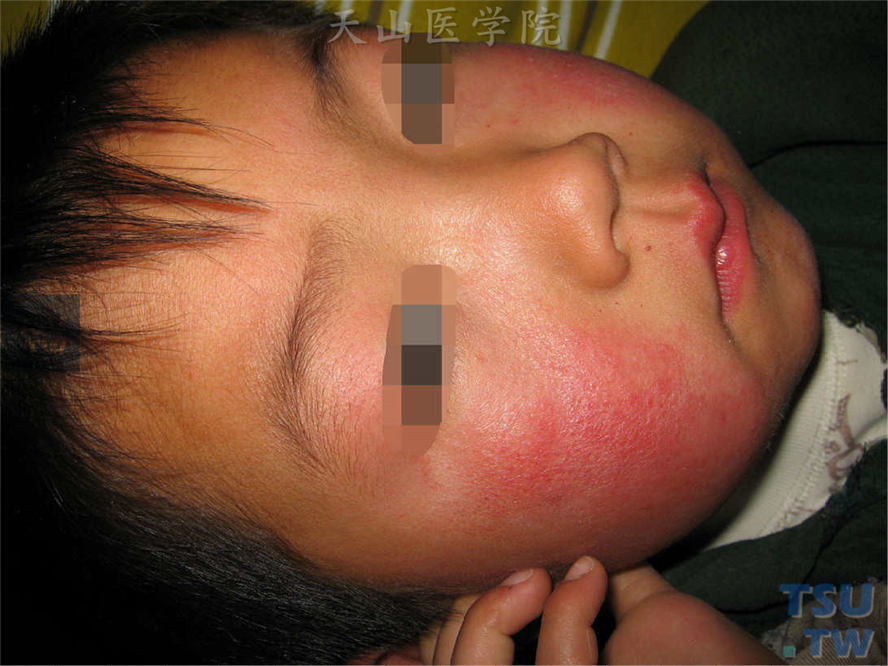 传染性红斑（erythemainfectiosum）症状表现