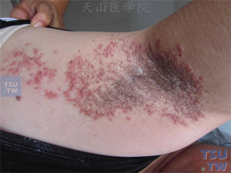 家族性良性慢性天疱疮的症状表现