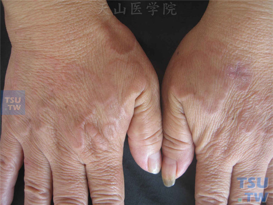 环状肉芽肿（granuloma annulare）症状表现
