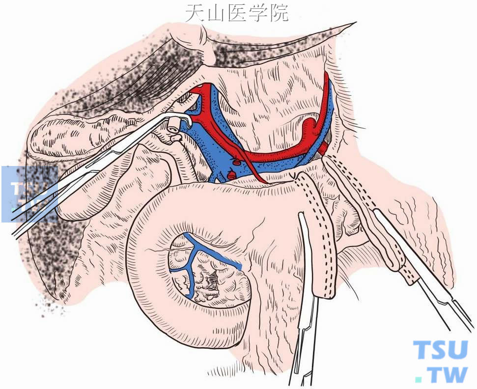 全胰切除术