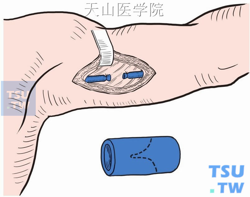 自体带瓣（腋或肱）静脉段股浅静脉移植术