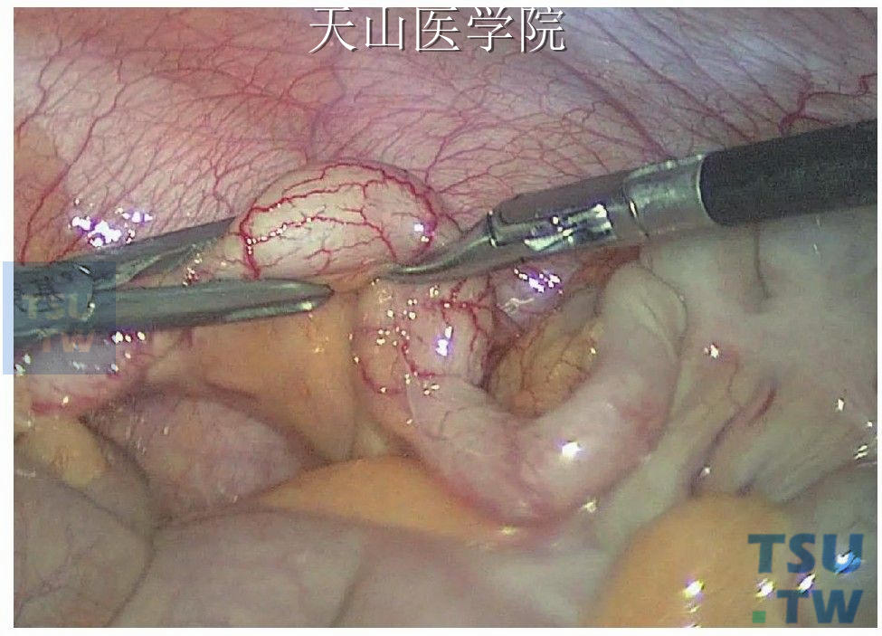 腹腔镜阑尾切除术
