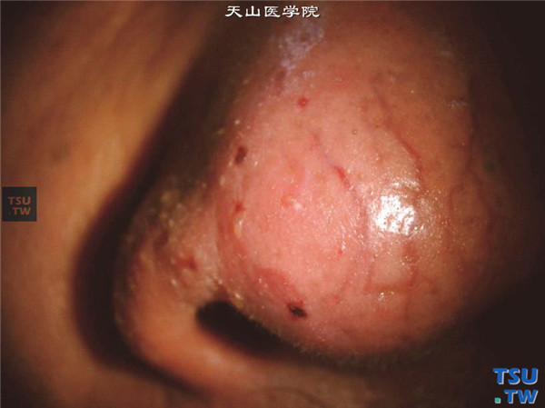 酒渣鼻性角膜炎及其症状图解