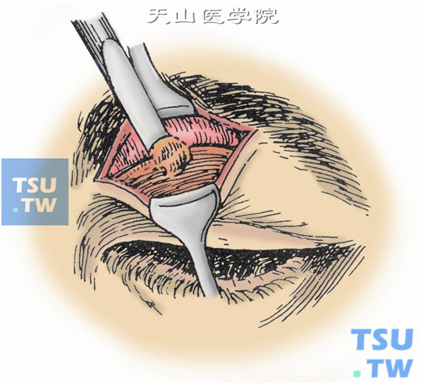 鼻上进路眼眶肿瘤摘除术
