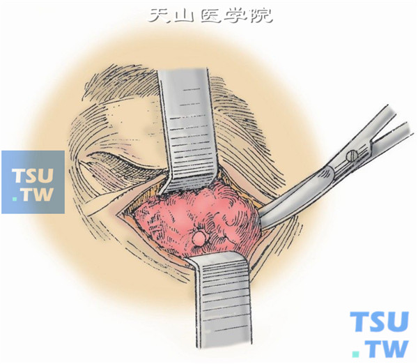 眶下缘进路眼眶肿瘤摘除术
