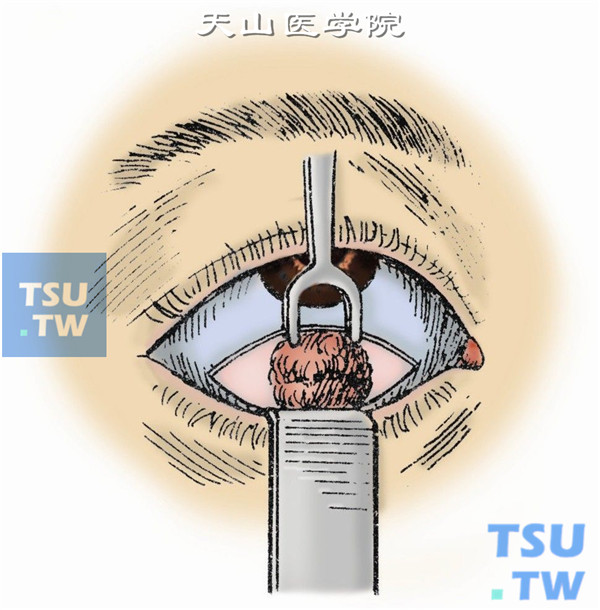 穹窿部结膜进路眼眶肿瘤摘除术