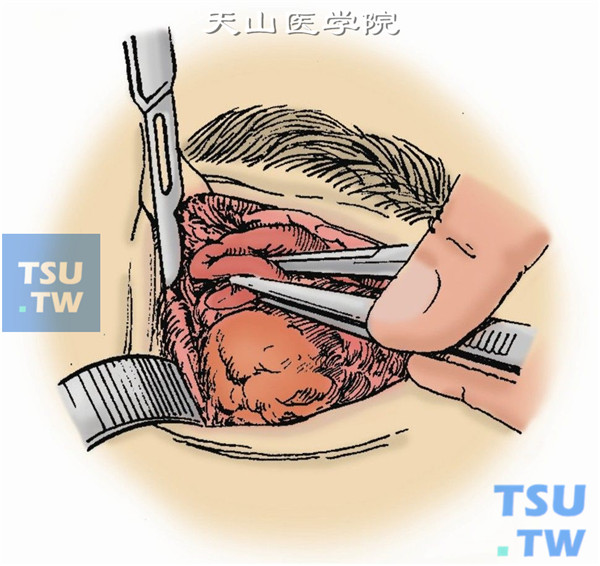眶内容剜出术